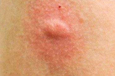Swollen Cockroach Bite Mark On Skin